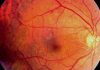 Retinopati Diabetik, Risiko Kesehatan yang Mengintai Anak Muda